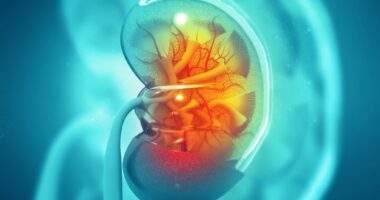 kidney stones, calcification, significantly higher risk